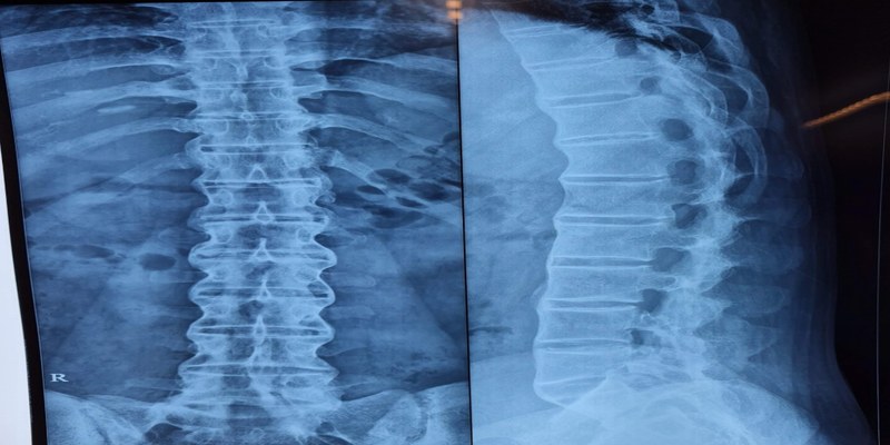 Ankylosing Spondylitis — bamboo spine X-ray AP and lateral views