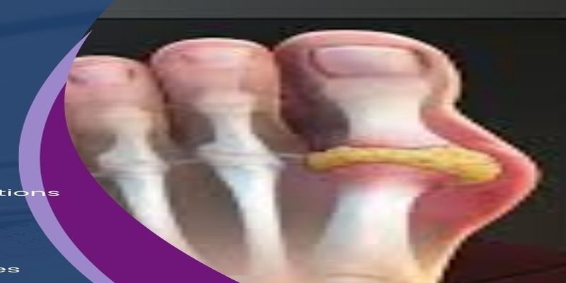 Gout — uric acid crystals and inflamed toe joint