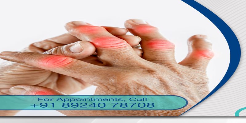 Rheumatoid arthritis — swollen inflamed joints